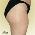 After Endermologie Picture