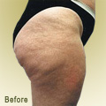 Before Endermologie Picture
